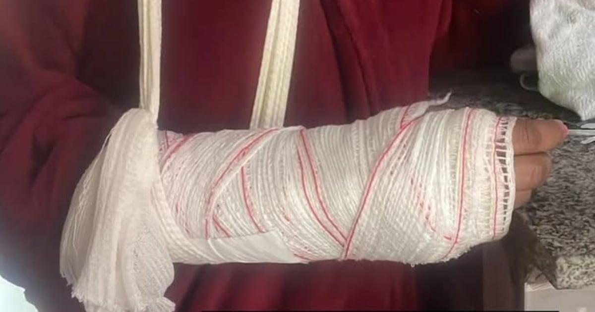 Manicure tem braço quebrado durante agressão e pede medida protetiva contra sobrinho na Grande BH